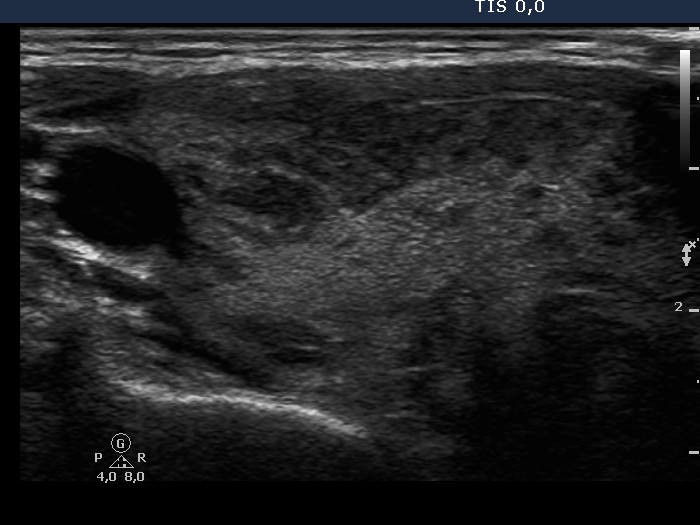 Right lobe, longitudinal scan