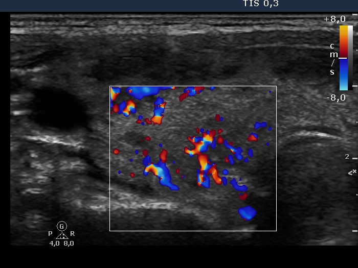 Right lobe, longitudinal scan