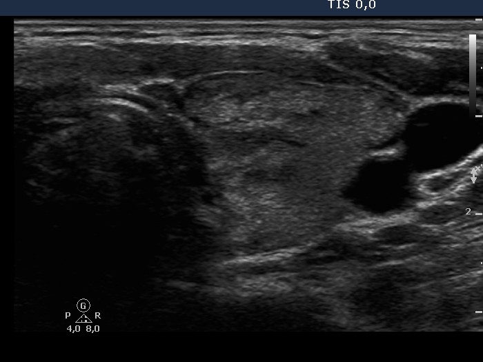Right lobe, longitudinal scan