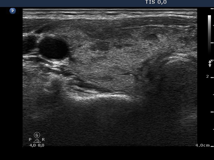 Right lobe, longitudinal scan