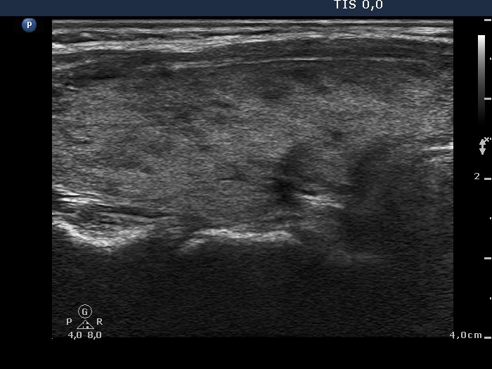 Right lobe, longitudinal scan