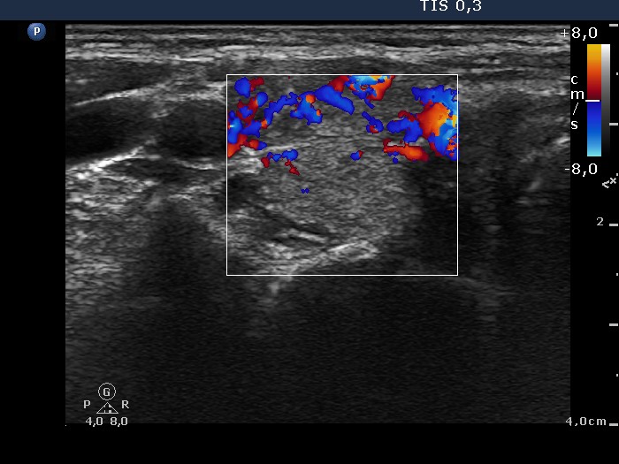 Right lobe, longitudinal scan