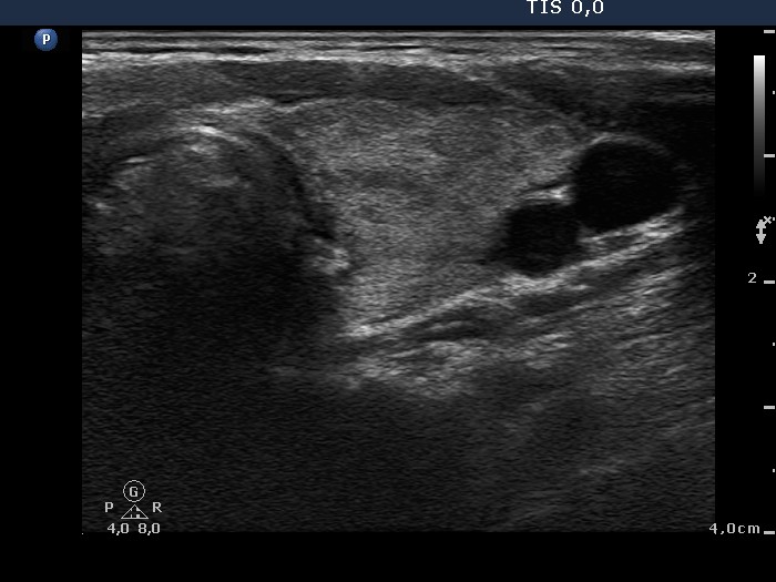 Right lobe, longitudinal scan