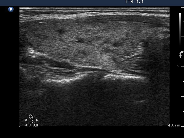 Right lobe, longitudinal scan