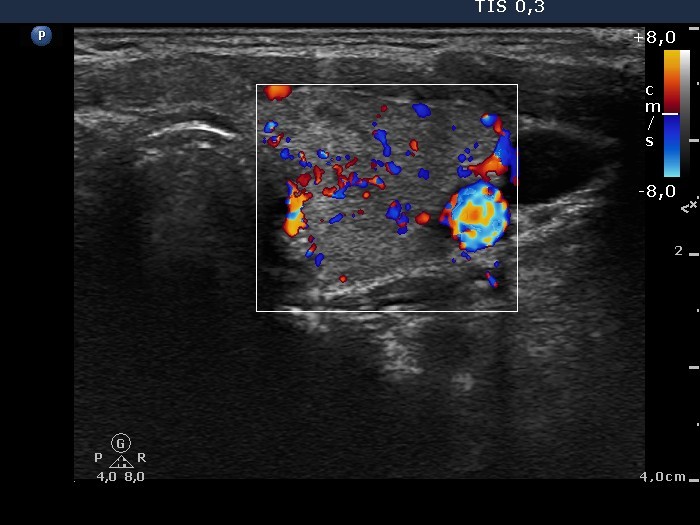 Right lobe, longitudinal scan