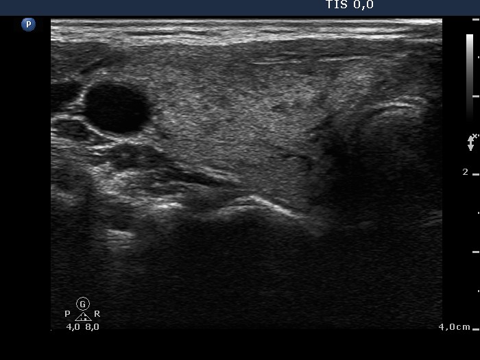 Right lobe, longitudinal scan