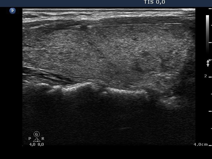 Right lobe, longitudinal scan