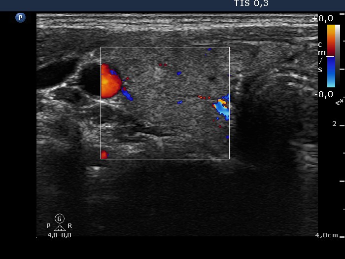 Right lobe, longitudinal scan