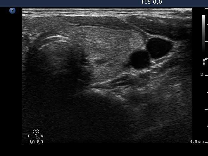 Right lobe, longitudinal scan