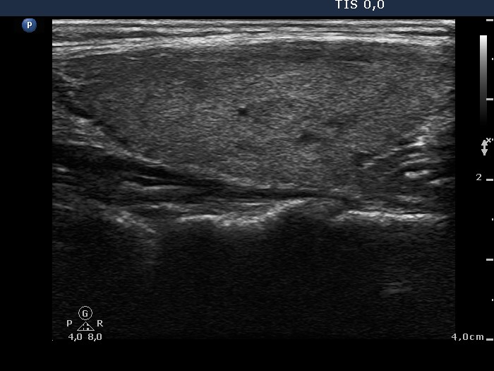 Right lobe, longitudinal scan