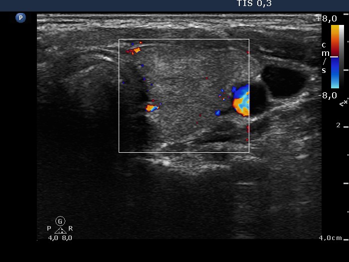 Right lobe, longitudinal scan
