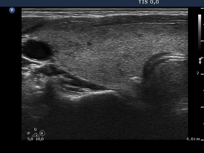 Right lobe, longitudinal scan