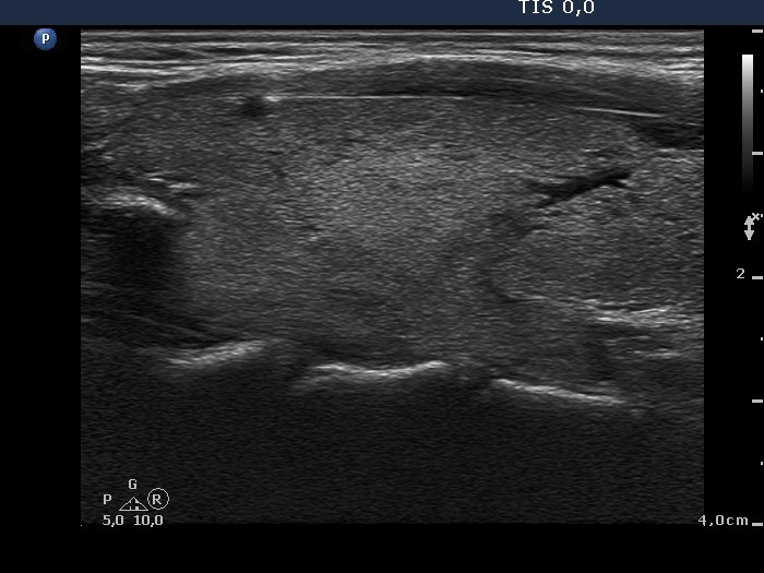 Right lobe, longitudinal scan