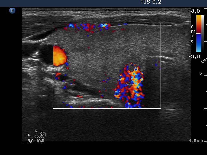 Right lobe, longitudinal scan