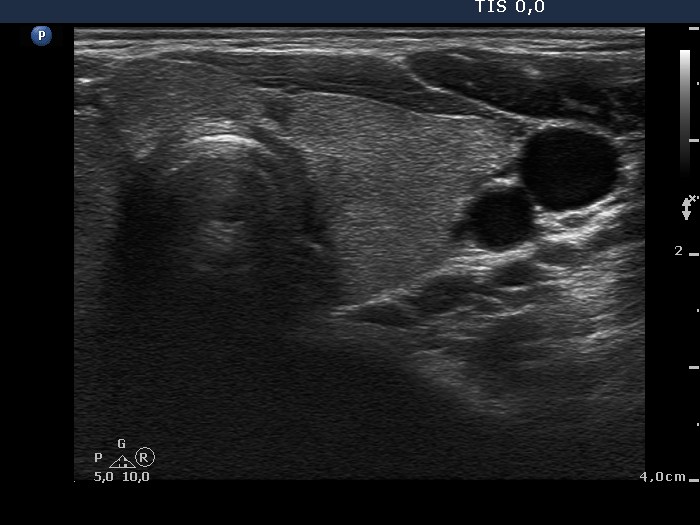 Right lobe, longitudinal scan