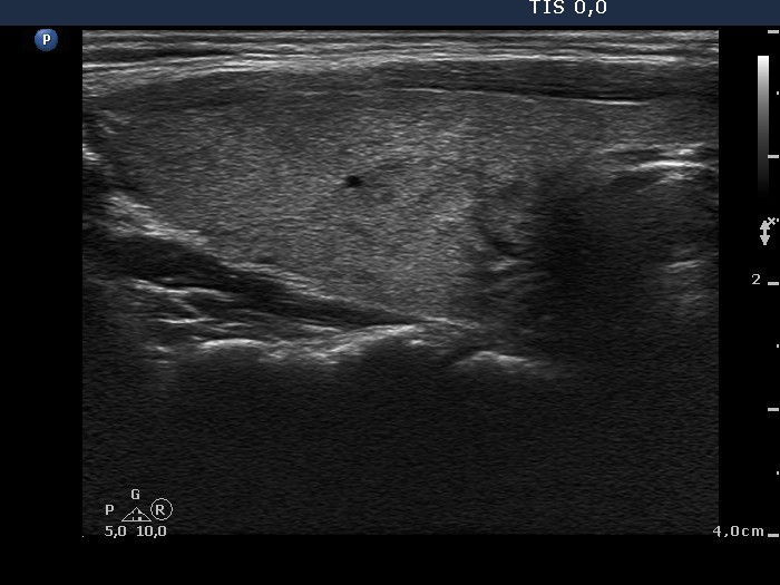 Right lobe, longitudinal scan