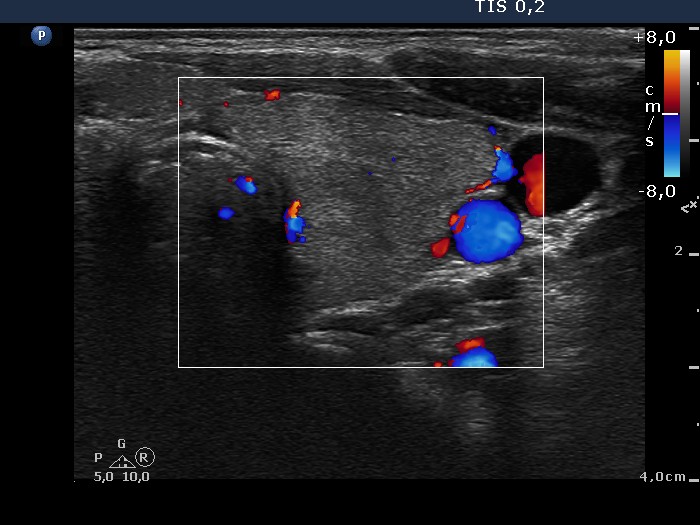 Right lobe, longitudinal scan