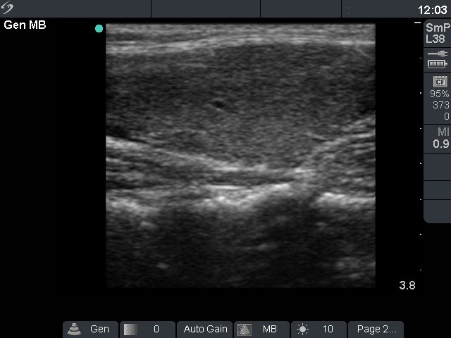 Right lobe, longitudinal scan