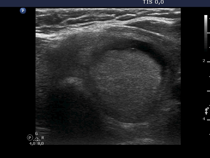 Right lobe, longitudinal scan