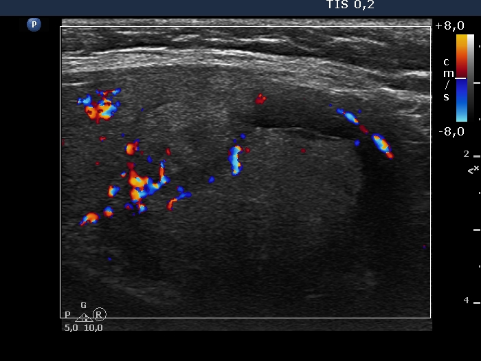 Right lobe, longitudinal scan