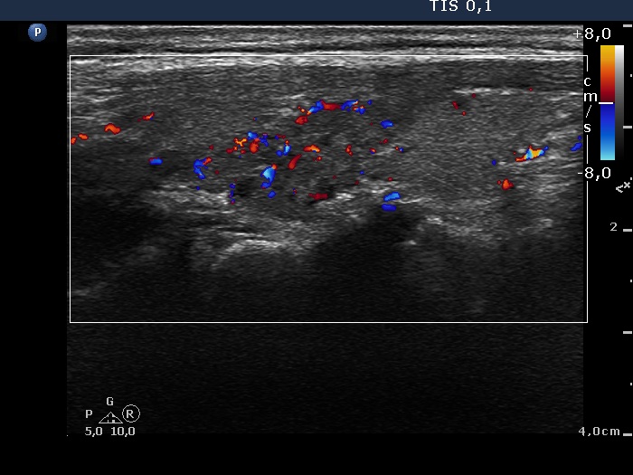 Right lobe, longitudinal scan
