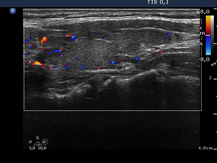 Right lobe, longitudinal scan