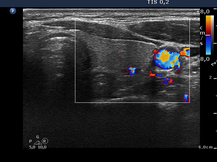 Right lobe, longitudinal scan