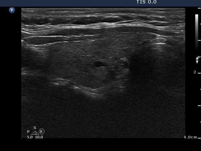 Right lobe, longitudinal scan