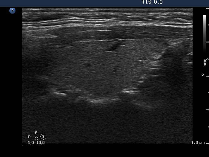 Right lobe, horizontal view
