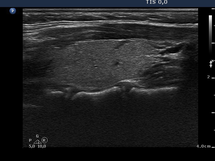 Right lobe, horizontal view