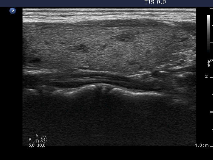 Right lobe, longitudinal scan