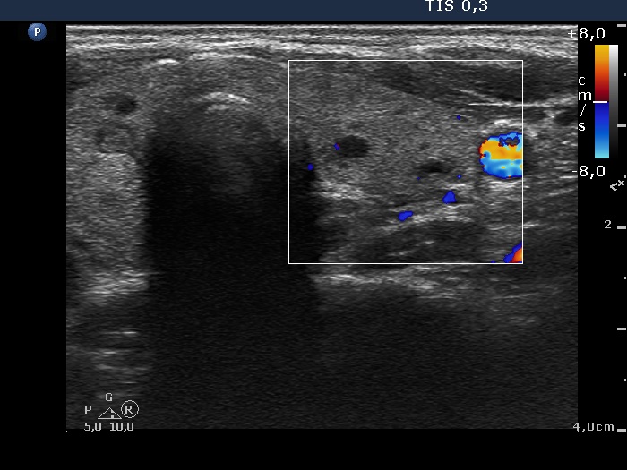 Right lobe, longitudinal scan