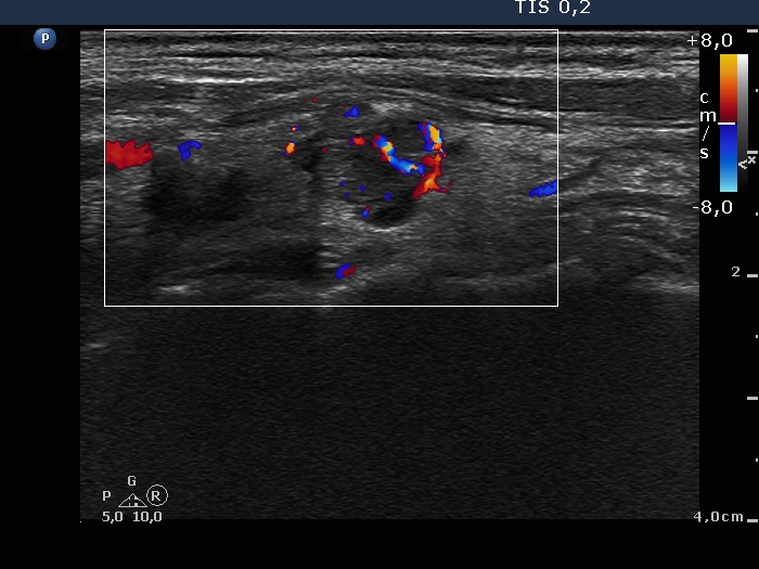 Right lobe, longitudinal scan