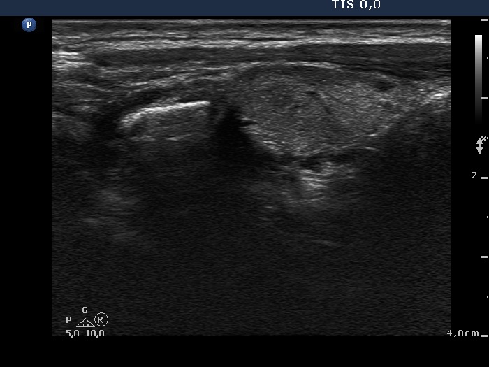 Right lobe, longitudinal scan