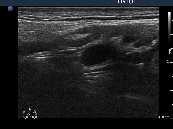 Right lobe, longitudinal scan