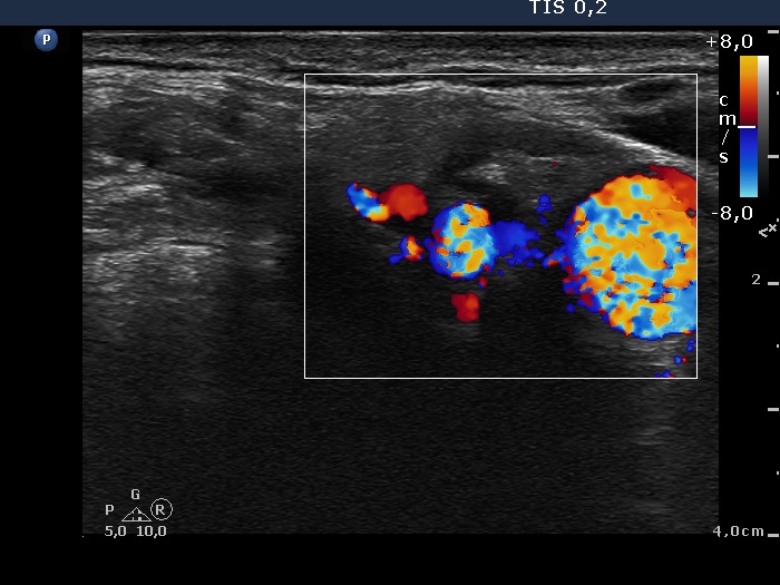 Right lobe, longitudinal scan