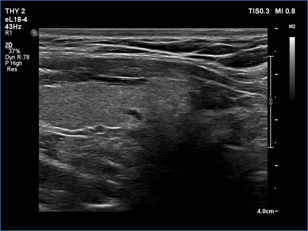 Right lobe, longitudinal scan