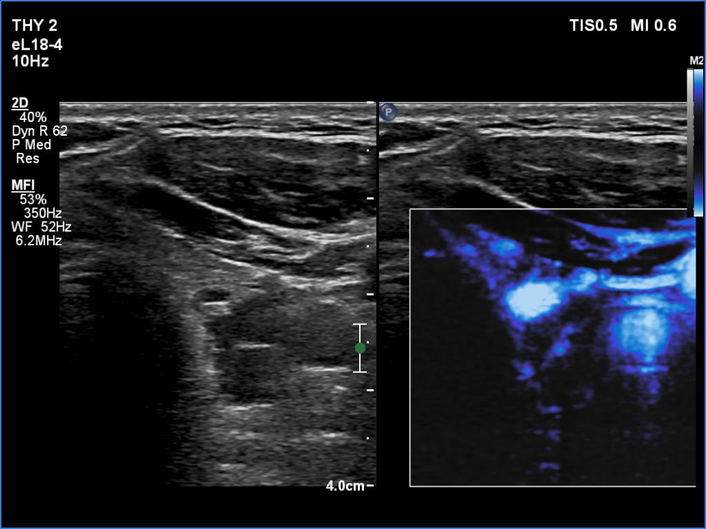 Right lobe, longitudinal scan