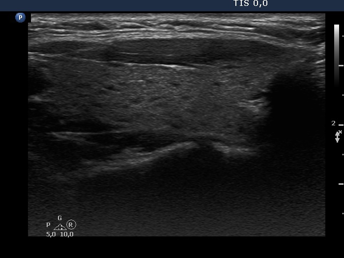 Right lobe, longitudinal scan