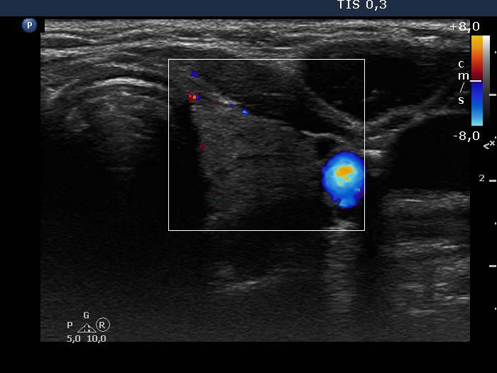 Right lobe, longitudinal scan