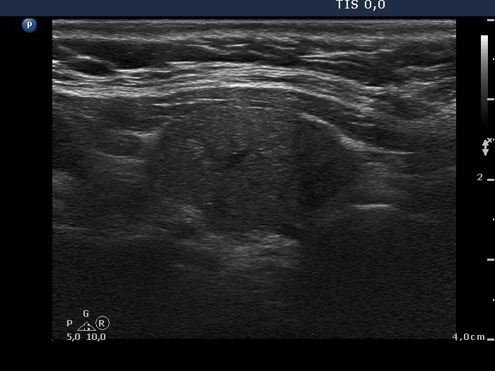 Right lobe, longitudinal scan