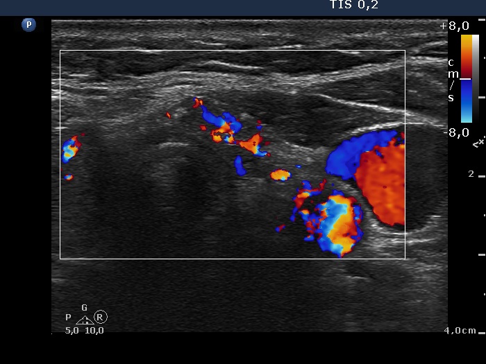 Right lobe, longitudinal scan