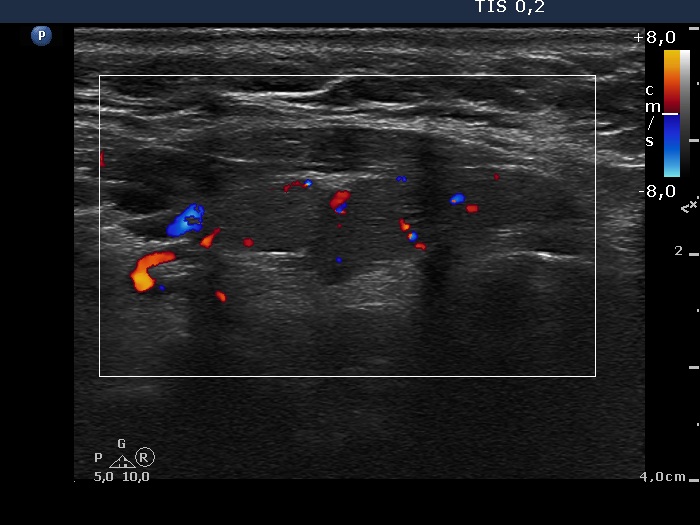 Right lobe, longitudinal scan