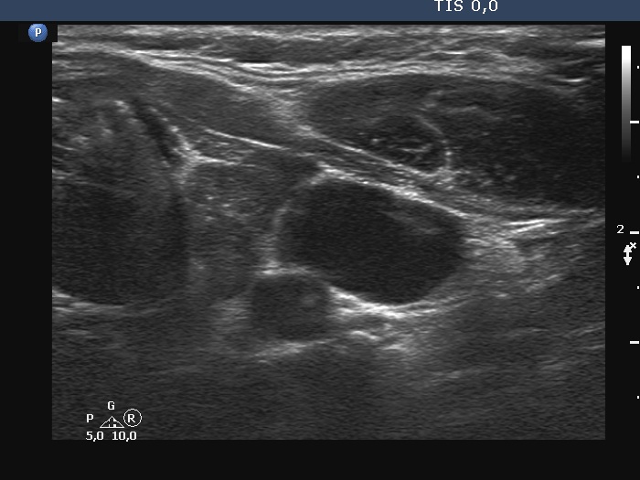 Right lobe, longitudinal scan