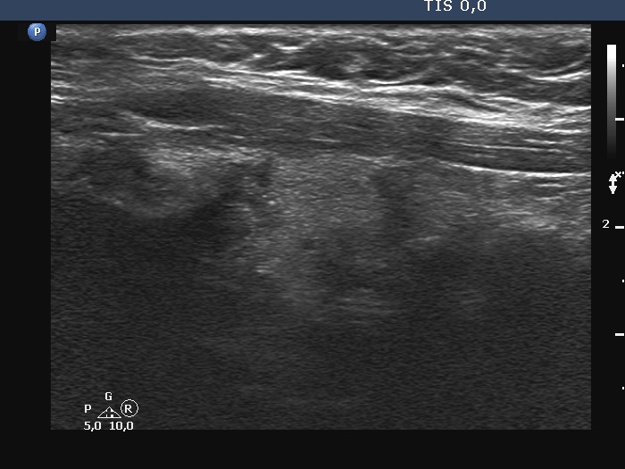 Right lobe, longitudinal scan