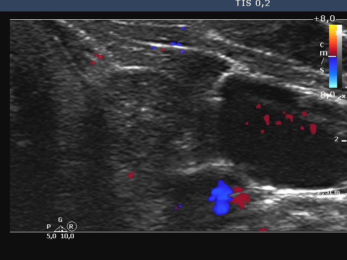 Right lobe, longitudinal scan