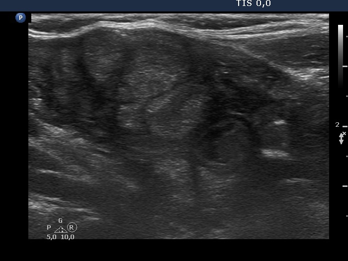 Right lobe, longitudinal scan