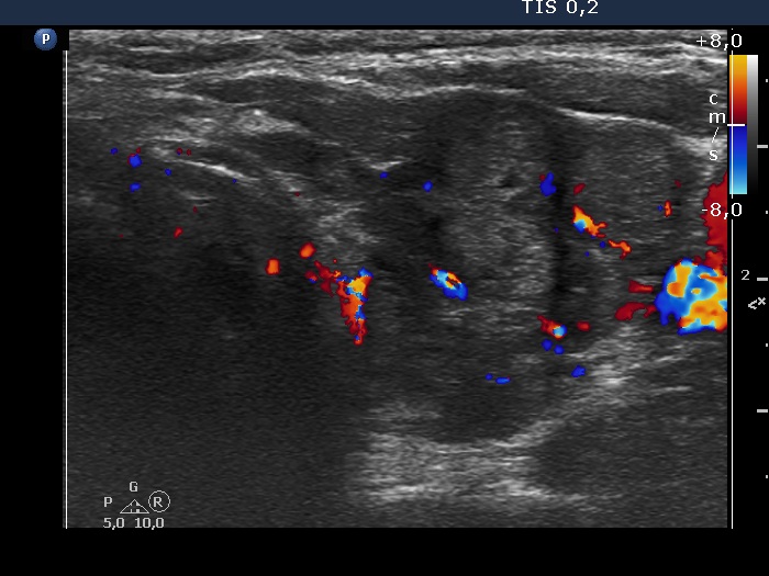 Right lobe, longitudinal scan