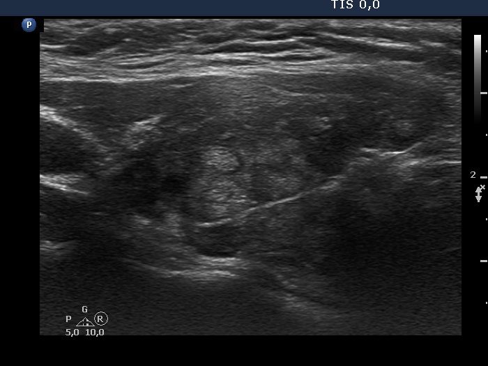 Right lobe, longitudinal scan