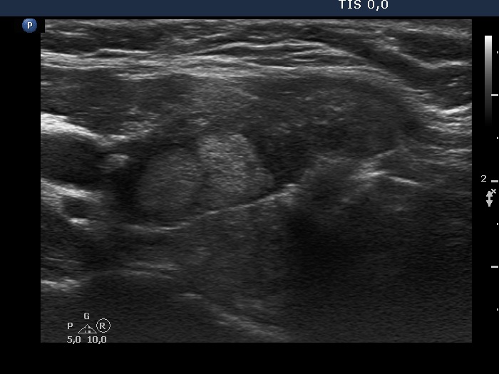 Right lobe, longitudinal scan